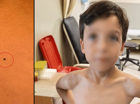 Oyun oynarken fark etti! 7 yaşındaki çocuğun göğsüne kene yapıştı
